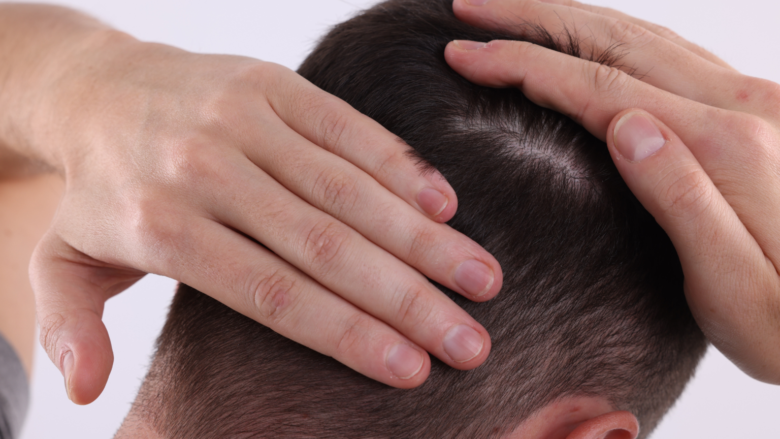 Il primo pianbo di una testa maschile con le mani che spostano i capelli per mostrare il cuoio capelluto