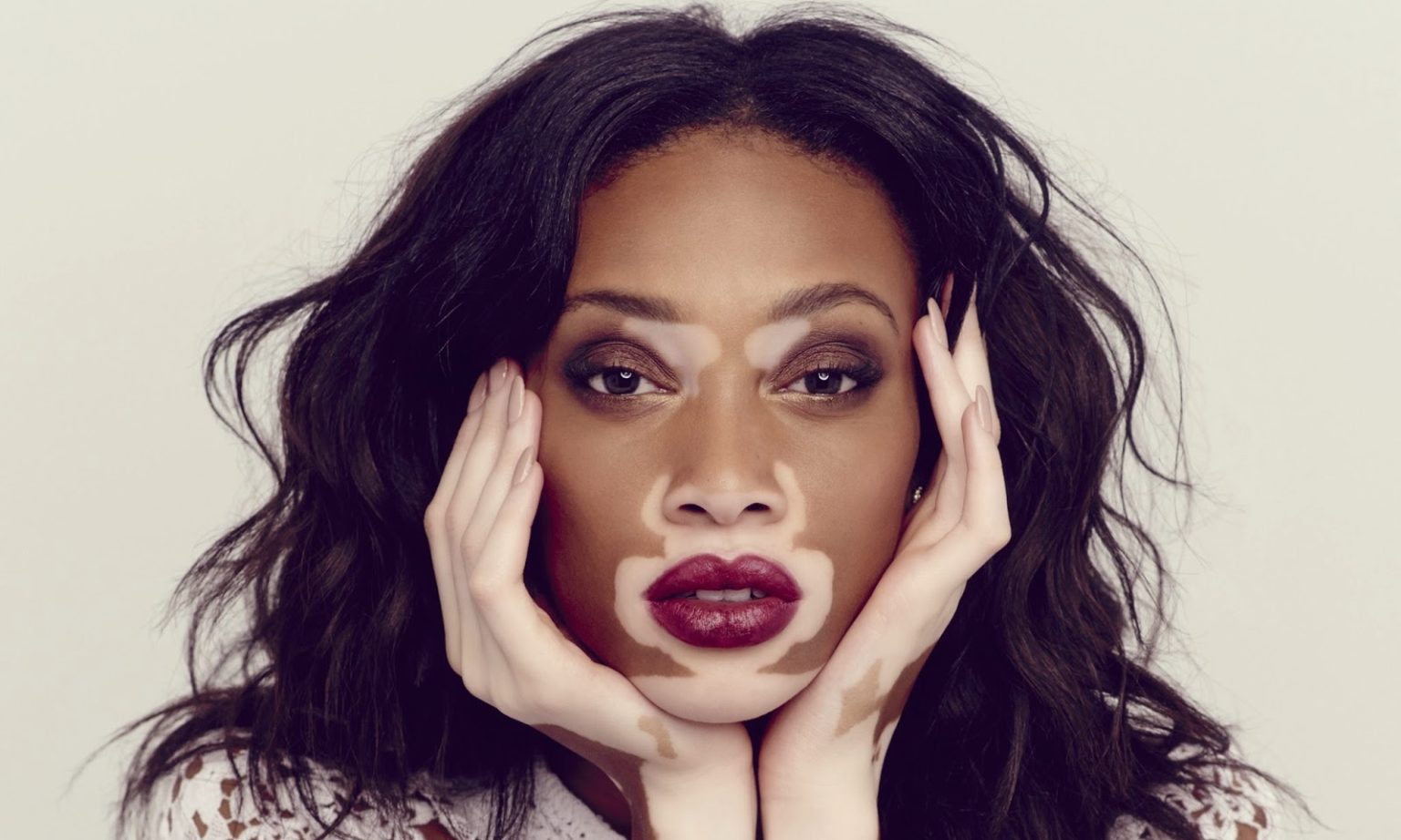 Il primo piano di una modella con le tipiche macchie cutanee dovute alla Vitiligine